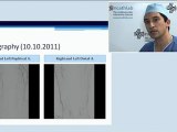 11 left superficial artery recanalization and stenting drug eluting stent incathlab.com