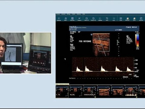 12 below knee by-pass graft instent restenosis and posterior tibial artery angioplasty incathlab.com