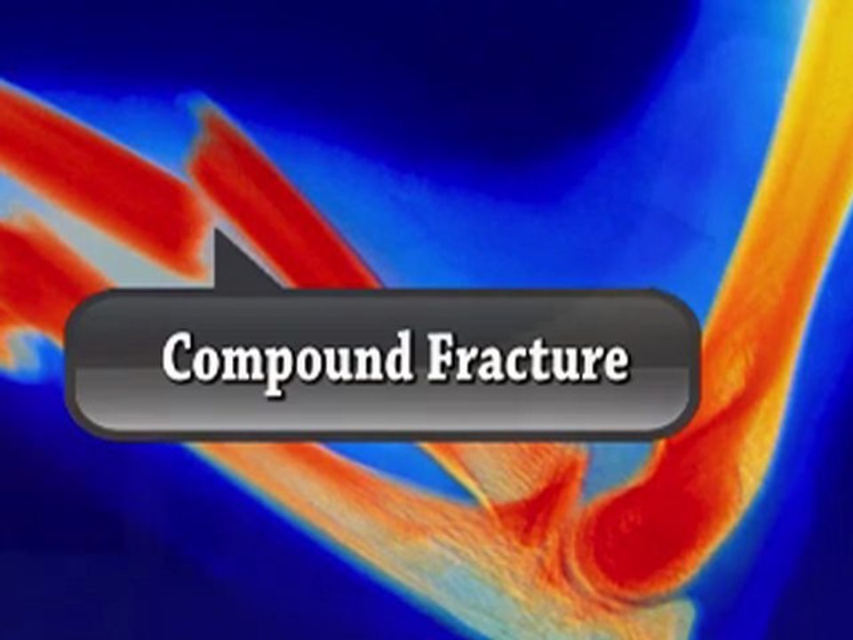 Broken Bones or Fractures - Orthopedist - Manahawkin, Barnegat, Little Egg Harbor, NJ