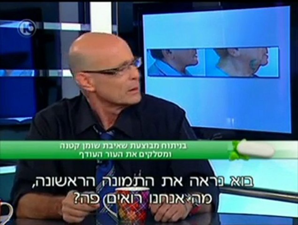 ניתוח הסרת סנטר כפול  - לפנים צעירות ורעננות