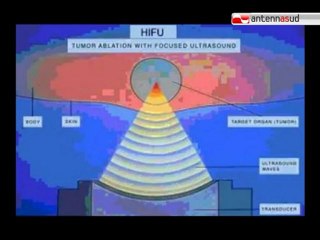 TG 08.03.12 Per curare il tumore arrivano gli ultrasuoni