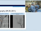 16 left carotid artery stenting and left renal stenting in one session incathlab.com