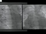 19 gastroepiploic graft pci and cx pci with rotablator incathlab.com