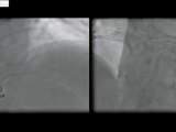 20 bilateral internal mammary artery graft angiogram - radial approach incathlab.com