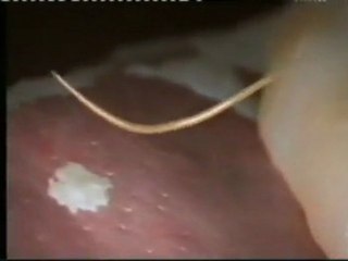 Anisakis: Gusanos parasitos en el pescado