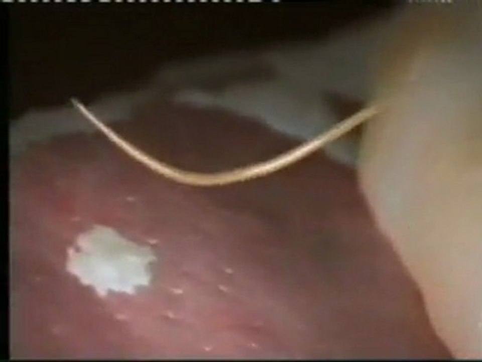 Anisakis: Gusanos parasitos en el pescado