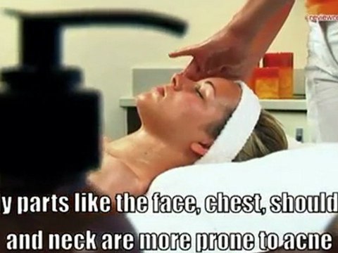 Revitol Scar Cream for Acne Scar Removal & Treatment-Before a Costly Option