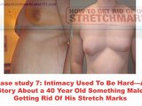 Remove Stretch Marks Naturally Home Remedies