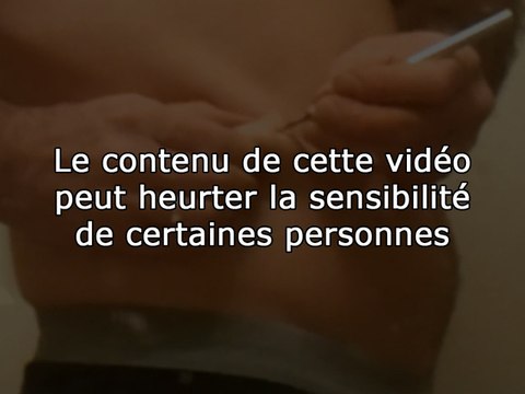 Il se retire tout seul une tumeur