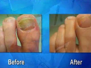 Laser Fungal Toenails - Toronto - Podiatrist, foot Doctor of Podiatric Medicine, Foot Specialist