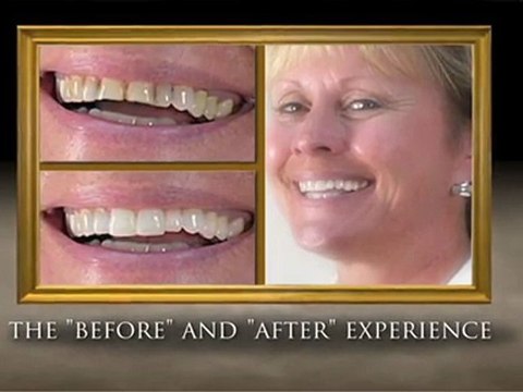 Porcelain Veneers & Crowns Shreveport & Bossier City, LA