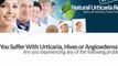urticaria pigmentosa - chronic urticaria - urticaria treatment