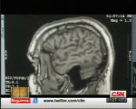 Daño cerebral: Estados de conciencia (El caso Patricio Meza)