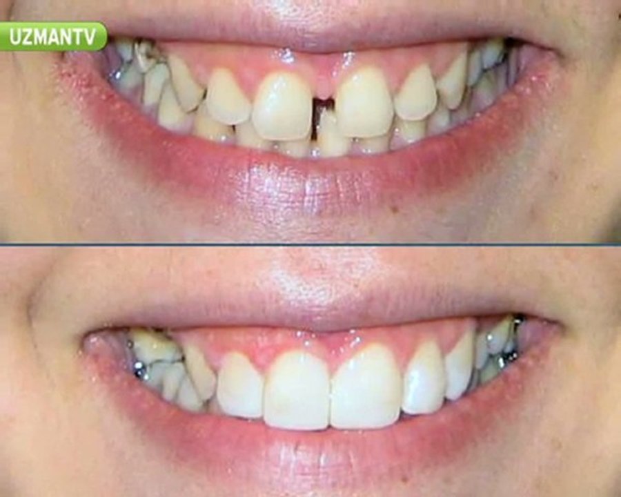 Gülüş estetiği nedir?-Ayça Kurt