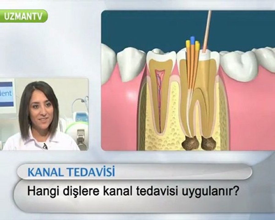 Kanal tedavisi tüm dişlere uygulanır mı?-Miray Uyan