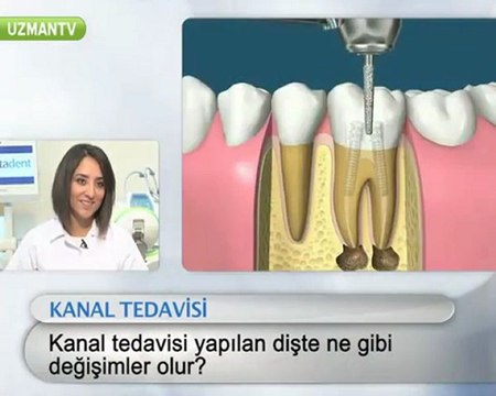 Kanal tedavisinde dişte ne gibi değişim olur?-Miray Uyan