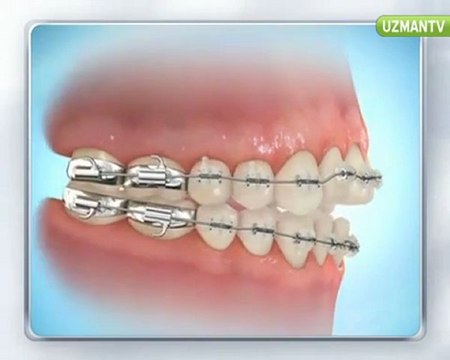 Diş teli kullanmadan ortonti tedavisi yapılır mı?-İlke Elgün