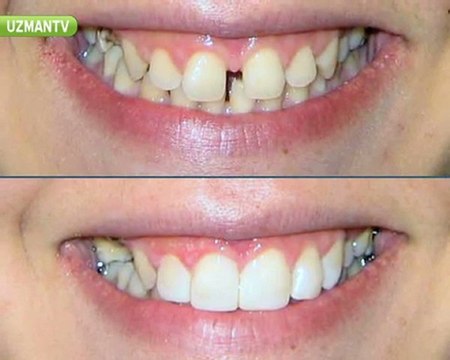 Gülüş estetiği ne demektir?-Ayça Kurt