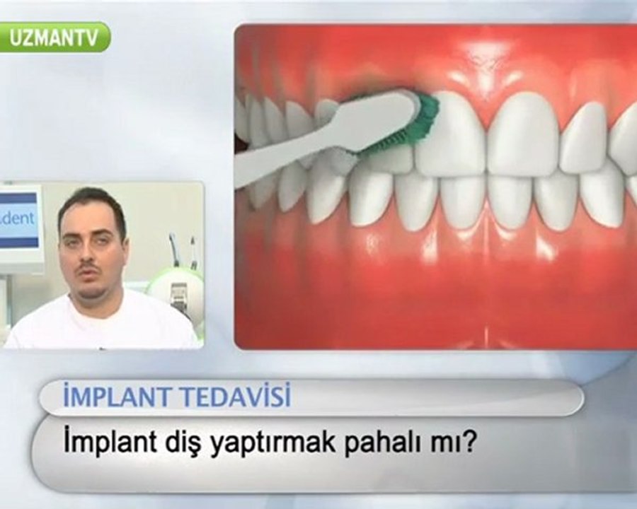 Implant (vidalı) diş yaptırmak pahalı mıdır?-Serkan Tüzün