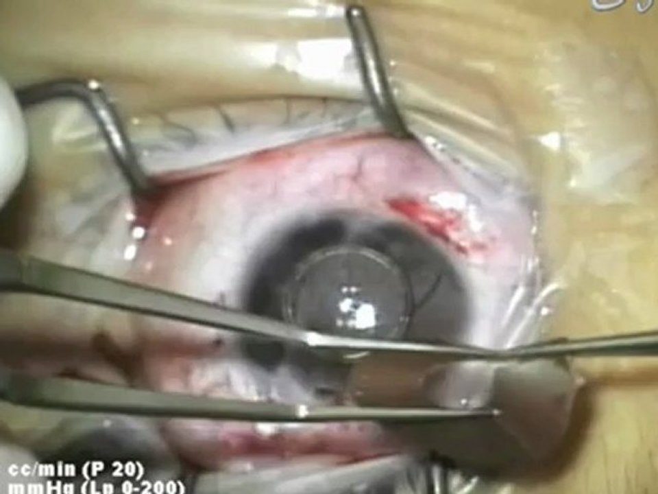 Dr. Yehia Salah Mostafa implants artificial iris bright ocular