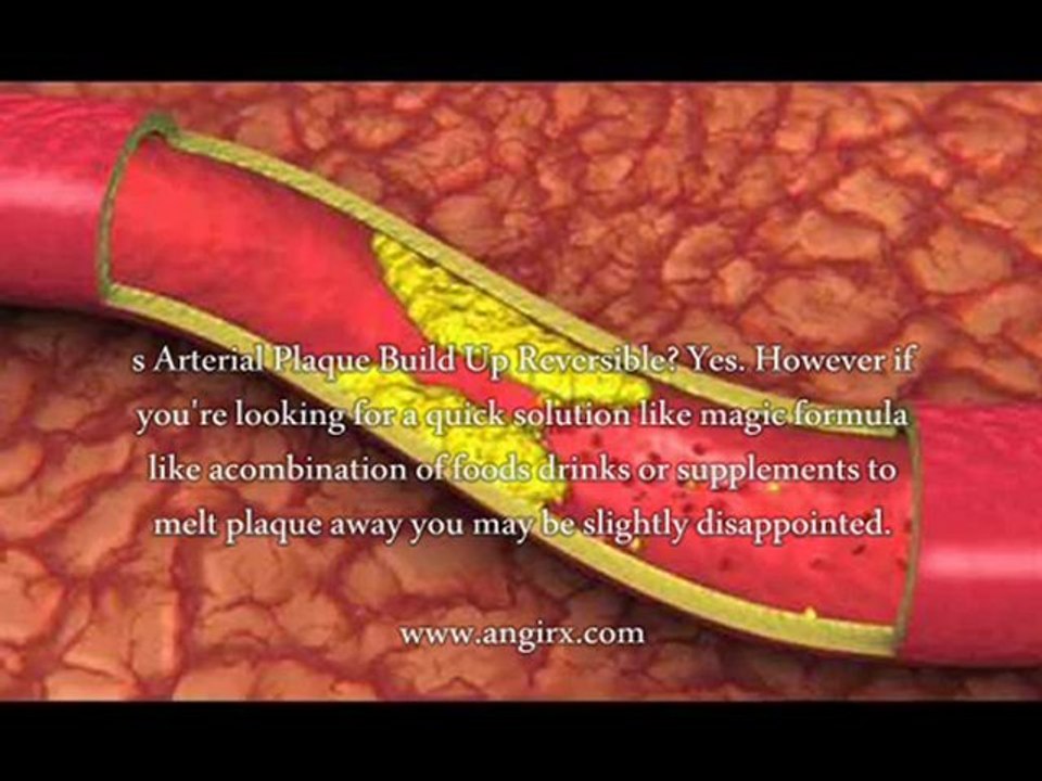 Is Arterial Plaque Build Up Reversible? video Dailymotion