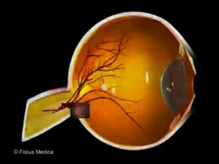 Color Blindness_Achromatopsia (Animated Pocket Dictionary_ Ophthalmology)