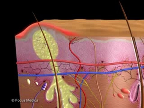 Acne (Animated Pocket Dictionary)