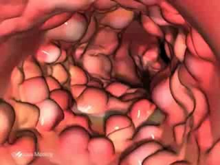 Inflammatory Bowel Disease_ Forms