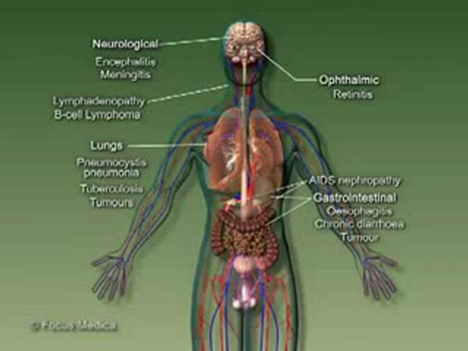 HIV_AIDS (Understanding Disease_ Infectious Diseases & Oncology)