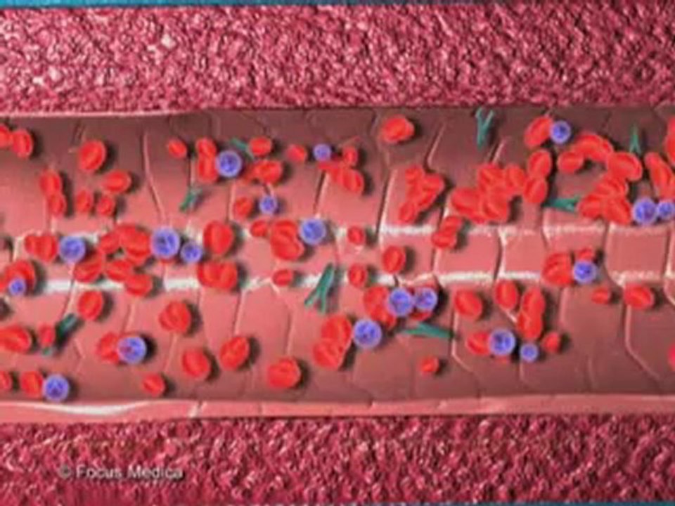 Allergy (Animated Pocket Dictionary)