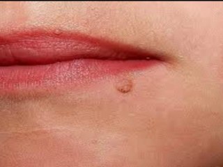 las verrugas-como librarse de ellas para siempre