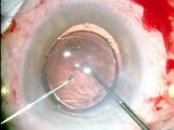 Complicated Cataract Surgery with Lens Cortex Luxation and Traumatic Iridodialysis Daniel Vilaplana