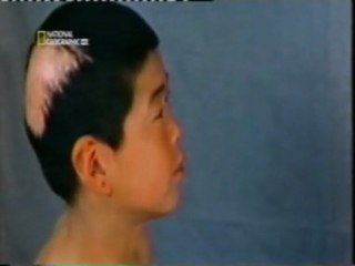 Estudio ABCC: Los supervivientes de Hiroshima (Efectos de la radiacion)