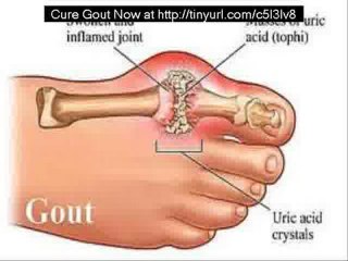 Natural Gout Cures