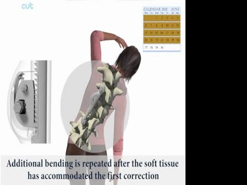 ApiFix Less Invasive Scoliosis Correction System