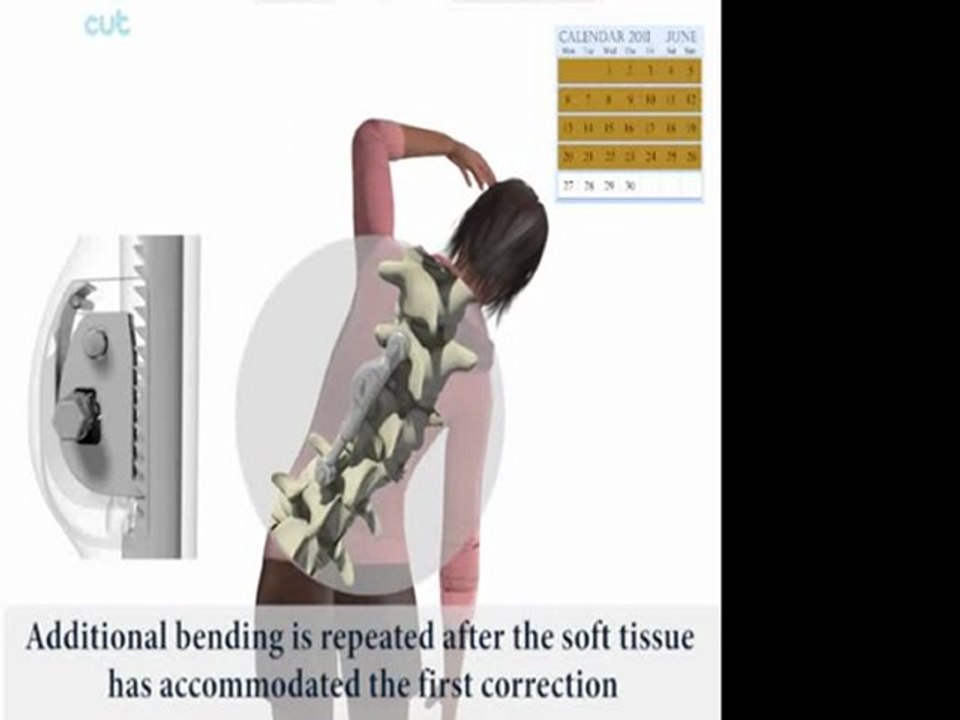 ApiFix Less Invasive Scoliosis Correction System