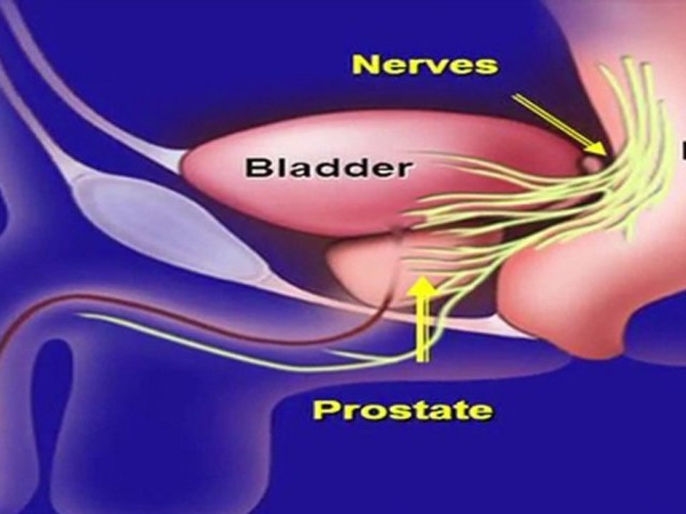 Intricate Prostate Cancer Surgery