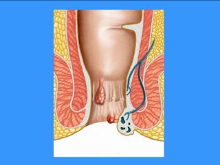 Blood in Stool Causes: Is This Hemorrhoids?