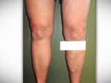 Spider Vein Treatment Kansas City, Varicose Vein Treatment