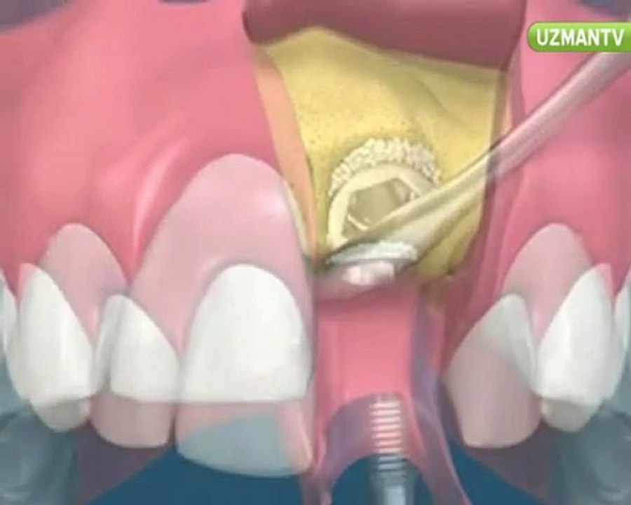 Dr. Nihat Tanfer - İmplant diş nasıl yapılır-