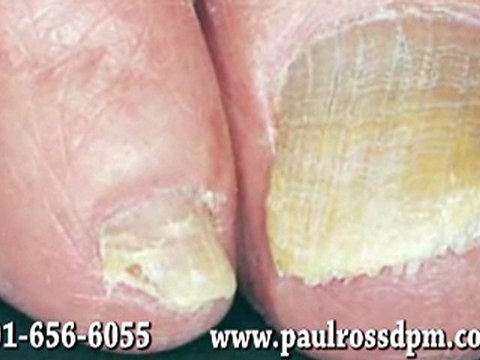 Fungal Toenails - Podiatrist in Bethesda, MD and Springfield, VA