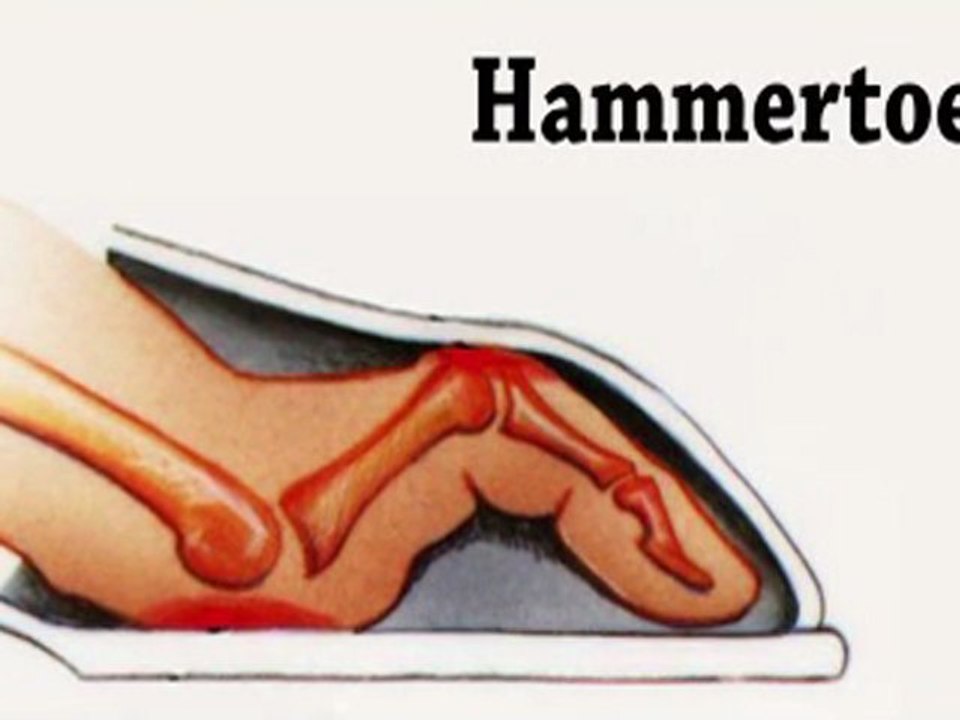 Hammertoes - Podiatrist in Bethesda, MD and Springfield, VA