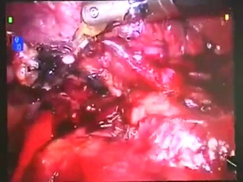 Robotic Surgery: Lung Surgery with the daVinci Robotic System