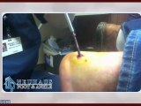 Dr. Matthew Neuhaus Removes Screw from Patient's Foot after Ankle Surgery
