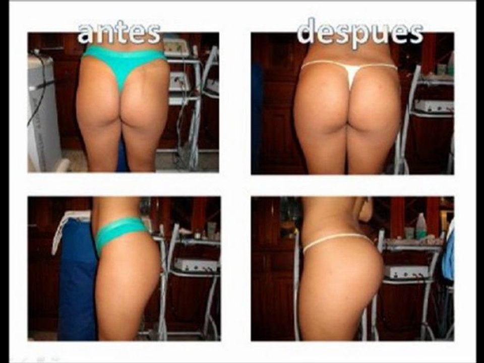 implantes para gluteos ya!