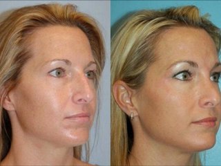 cirugia plastica nariz