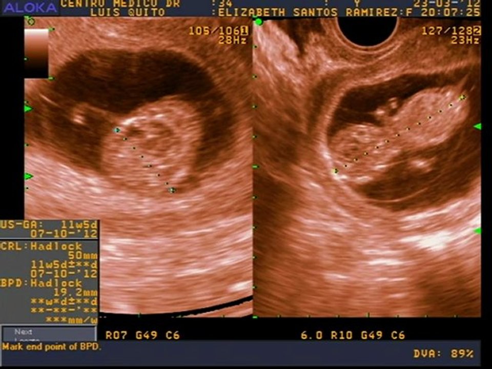 Ecografía 4D 11 Semanas