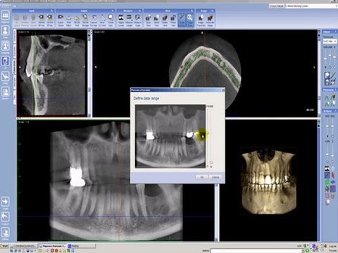 Planificacion de implante, Etapa 1 Orientación de la imagen