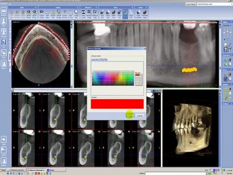 Planificacion de implante, Etapa 2 Marque el nervio
