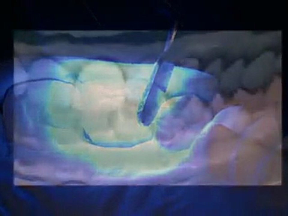 eFiber single tooth implant temporary provisional